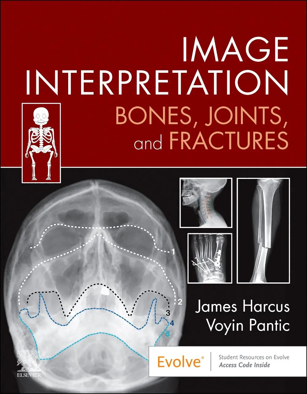 Cover: 9780323870801 | Image Interpretation: Bones, Joints, and Fractures | Harcus (u. a.)