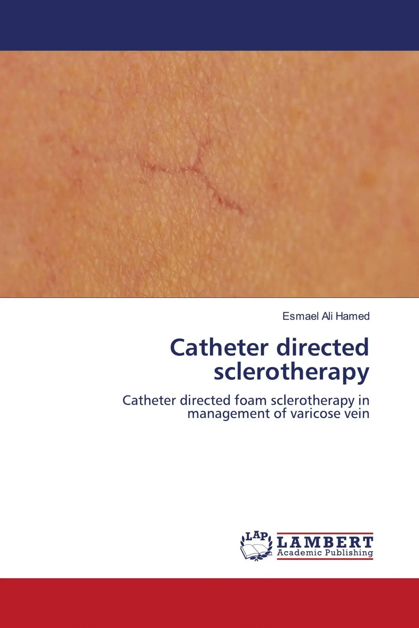 Cover: 9786203026702 | Catheter directed sclerotherapy | Esmael Ali Hamed | Taschenbuch