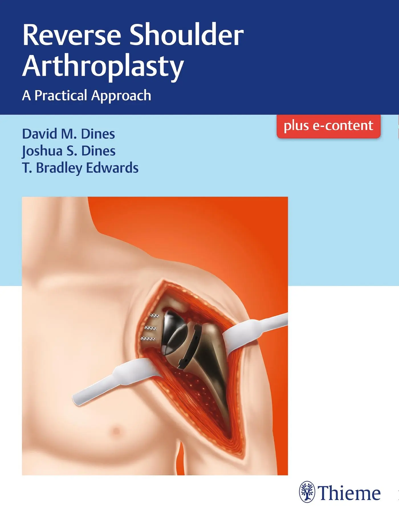 Cover: 9781626233607 | Reverse Shoulder Arthroplasty | A Practical Approach | Dines (u. a.)