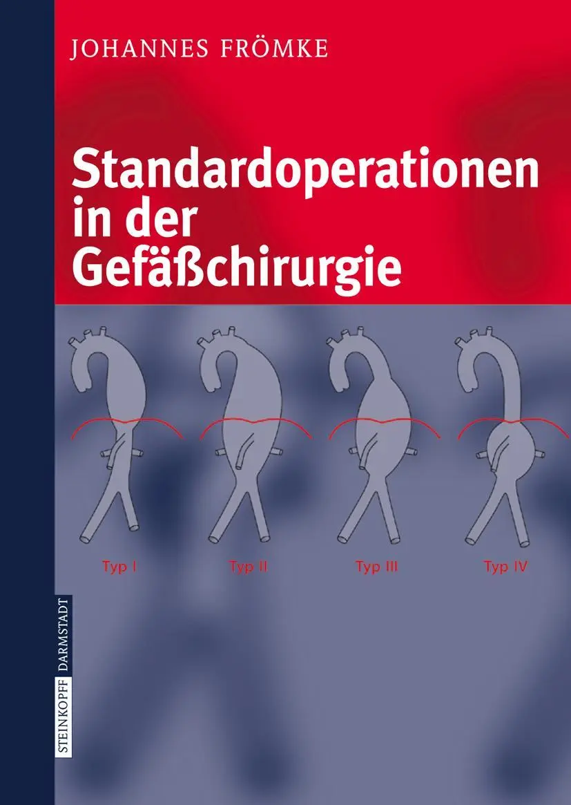 Cover: 9783798514607 | Standardoperationen in der Gefäßchirurgie | Johannes Frömke | Buch