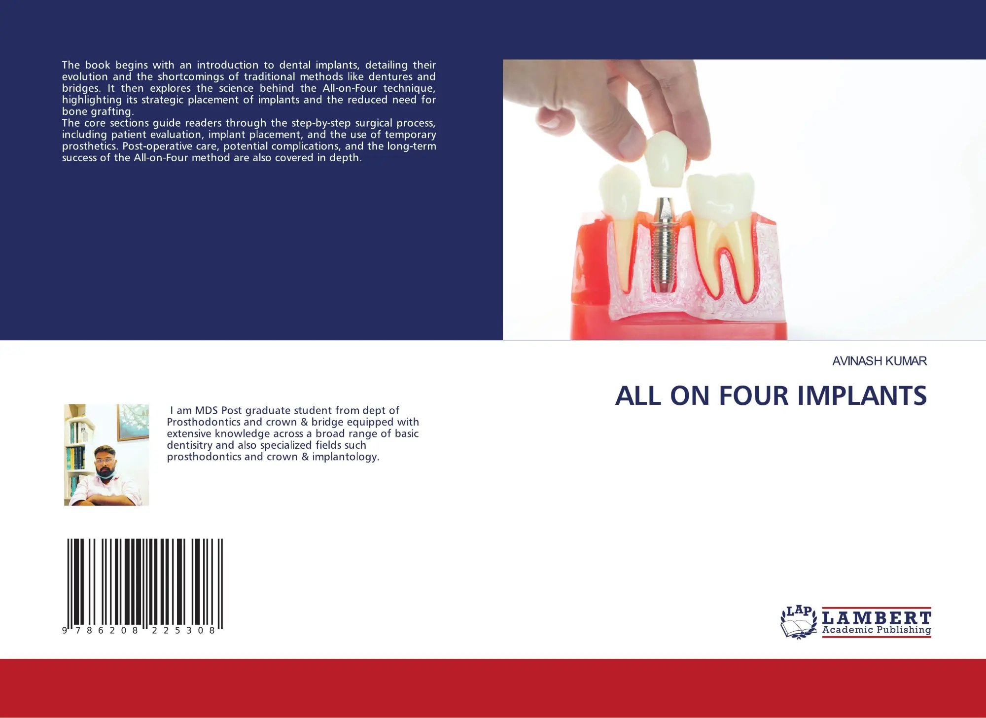 Cover: 9786208225308 | ALL ON FOUR IMPLANTS | Avinash Kumar | Taschenbuch | Englisch | 2024