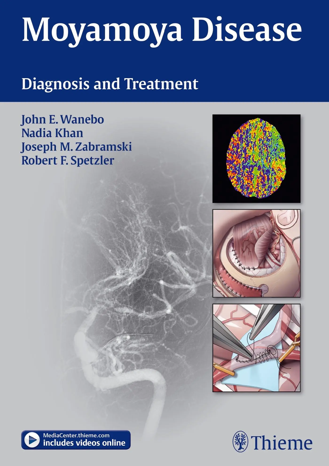 Cover: 9781604067309 | Moyamoya Disease | Diagnosis and Treatment | John E Wanebo (u. a.)