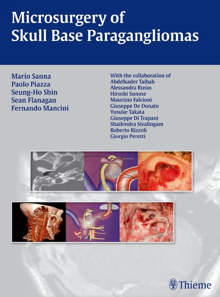 Cover: 9783131486110 | Microsurgery of Skull Base Paragangliomas | Sanna | Buch | 716 S.