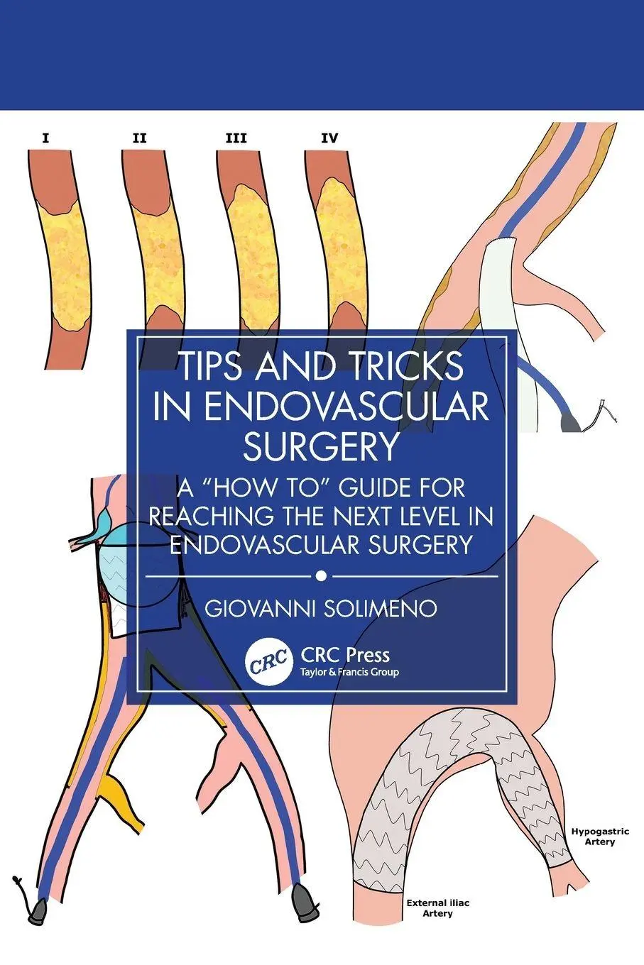 Cover: 9781032936710 | Tips and Tricks in Endovascular Surgery | Giovanni Solimeno | Buch