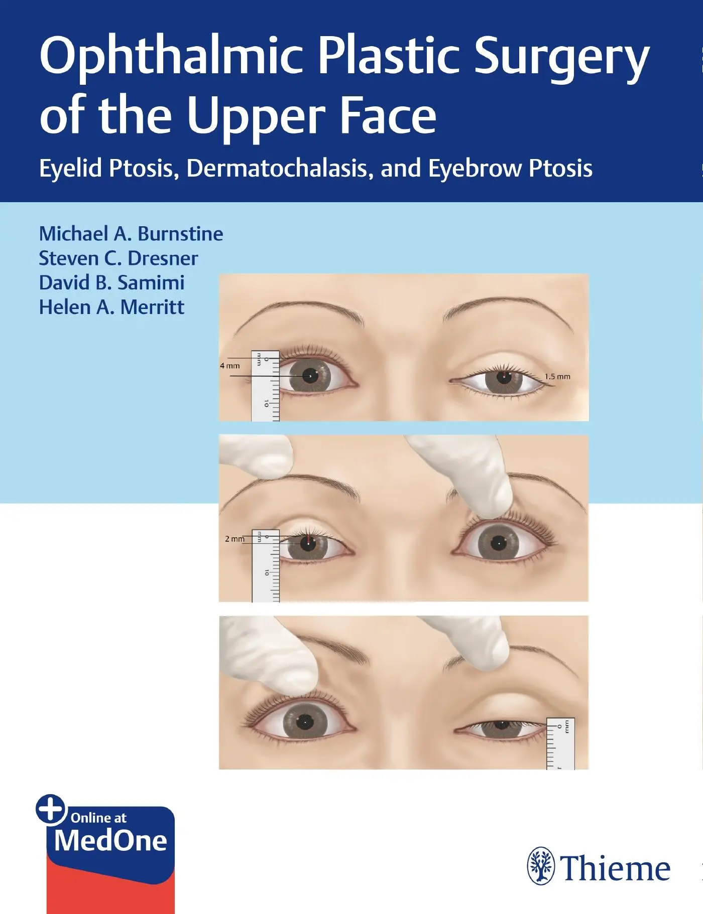 Cover: 9781626239210 | Ophthalmic Plastic Surgery of the Upper Face | Burnstine (u. a.)