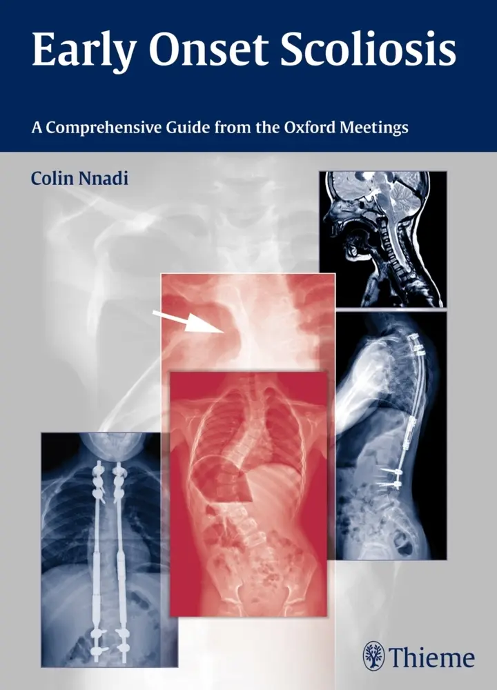 Cover: 9783131726612 | Early Onset Scoliosis | A Comprehensive Guide from the Oxford Meetings