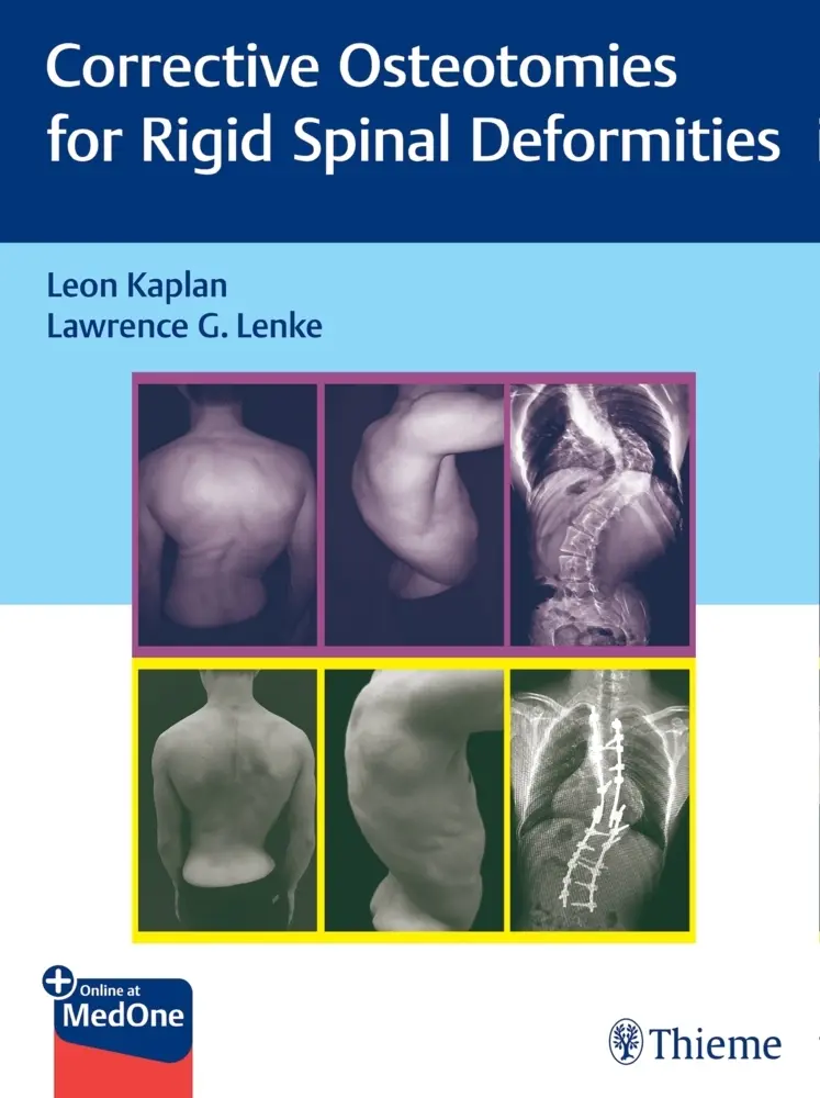 Cover: 9783131730817 | Corrective Osteotomies for Rigid Spinal Deformities | Kaplan (u. a.)