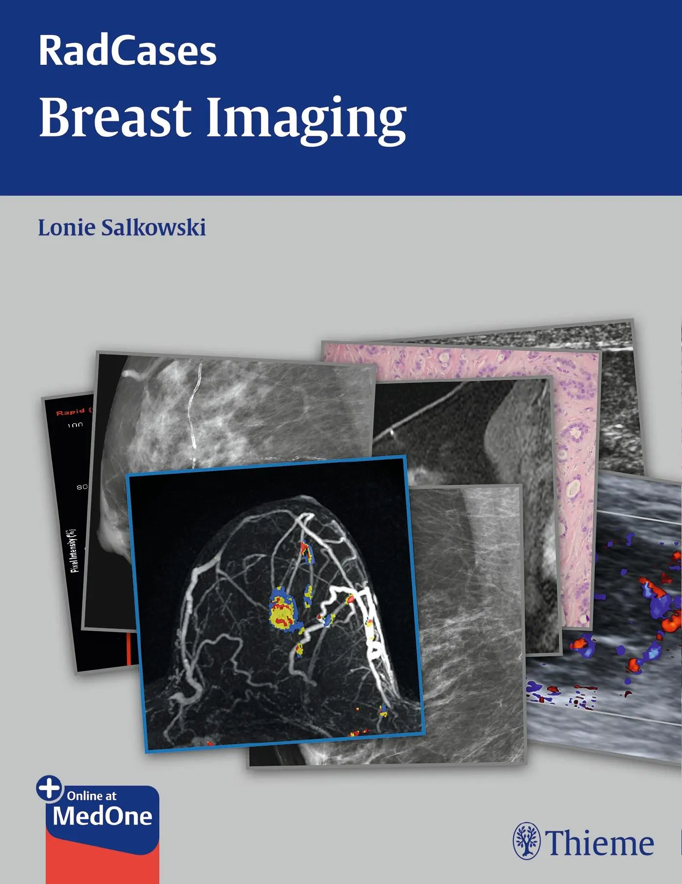 Cover: 9781604061918 | Radcases Breast Imaging | Lonie L Salkowski | Taschenbuch | 224 S.