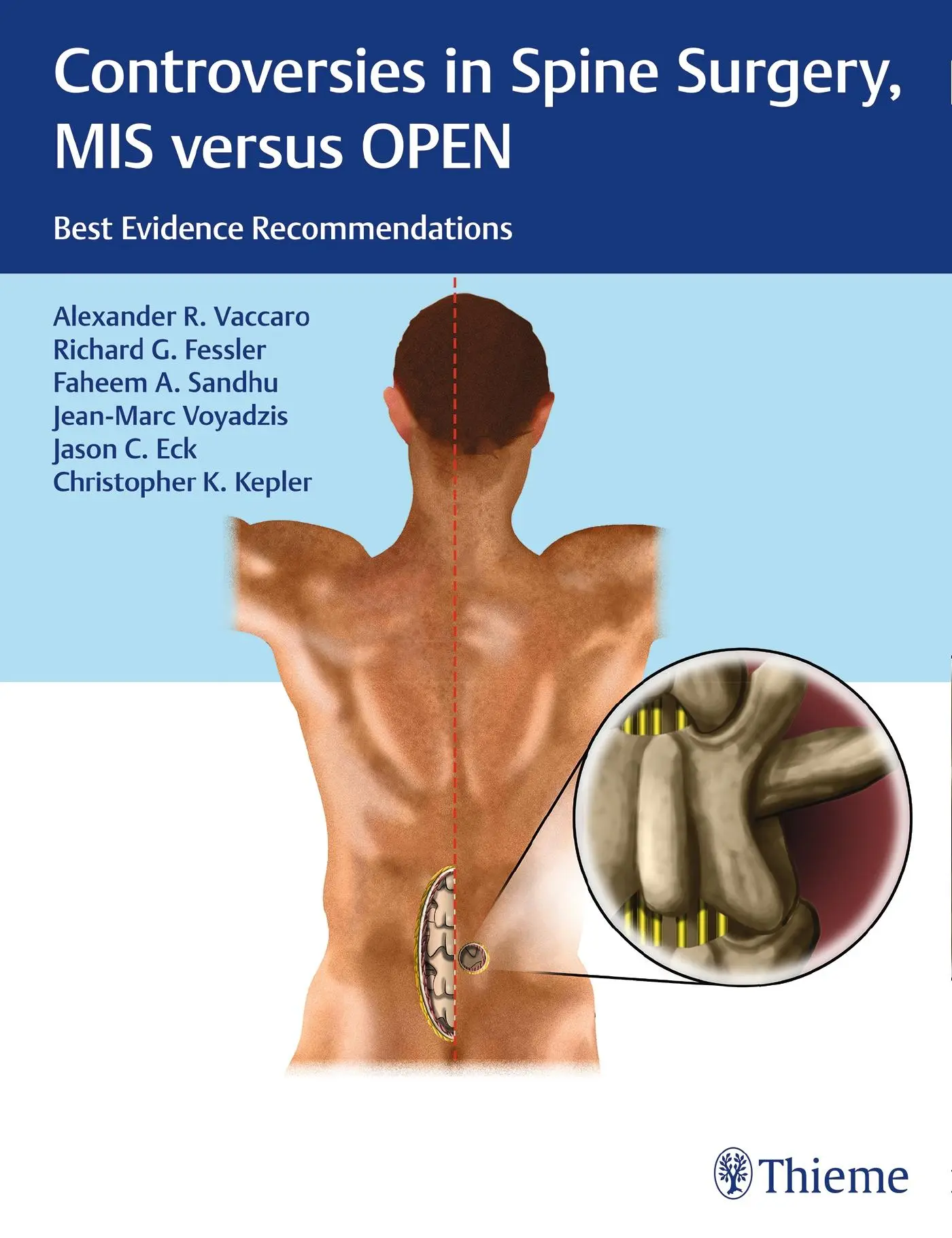 Controversies in Spine Surgery, MIS Versus Open