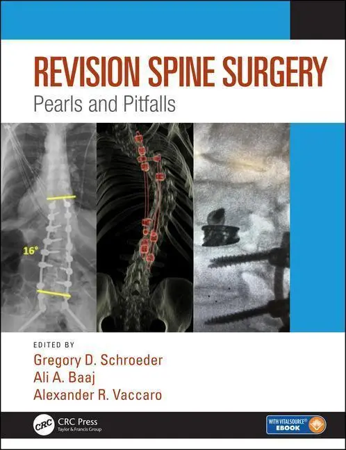 Cover: 9781498773829 | Revision Spine Surgery | Pearls and Pitfalls | University (u. a.)