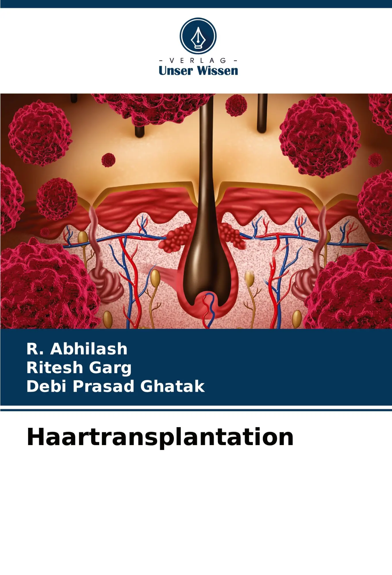 Cover: 9786206994930 | Haartransplantation | R. Abhilash (u. a.) | Taschenbuch | Paperback