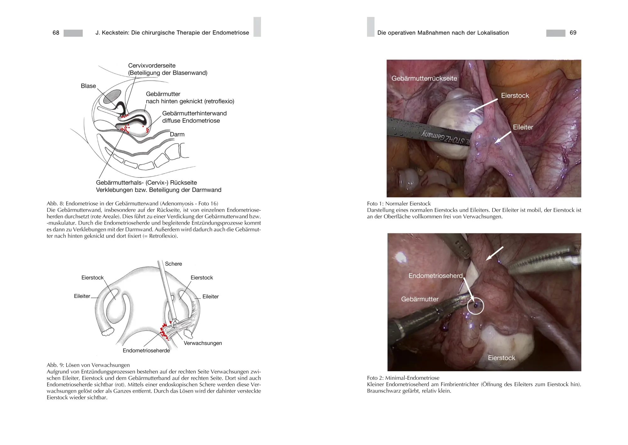Bild: 9783938580738 | Endometriose - Die verkannte Frauenkrankheit | Jörg Keckstein | Buch