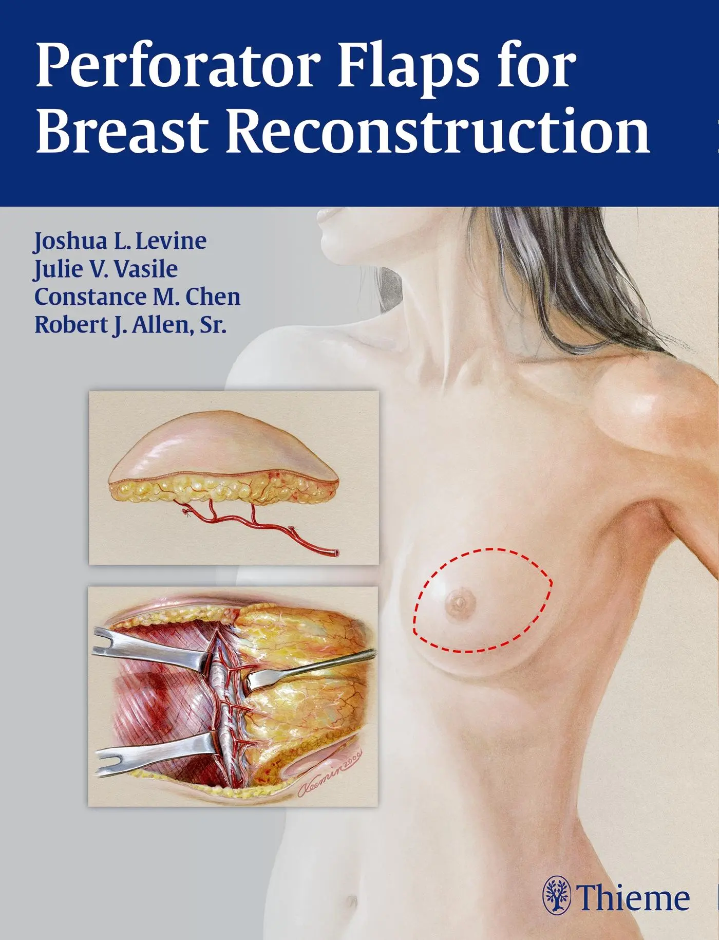Cover: 9781626230941 | Perforator Flaps for Breast Reconstruction | Joshua L Levine (u. a.)