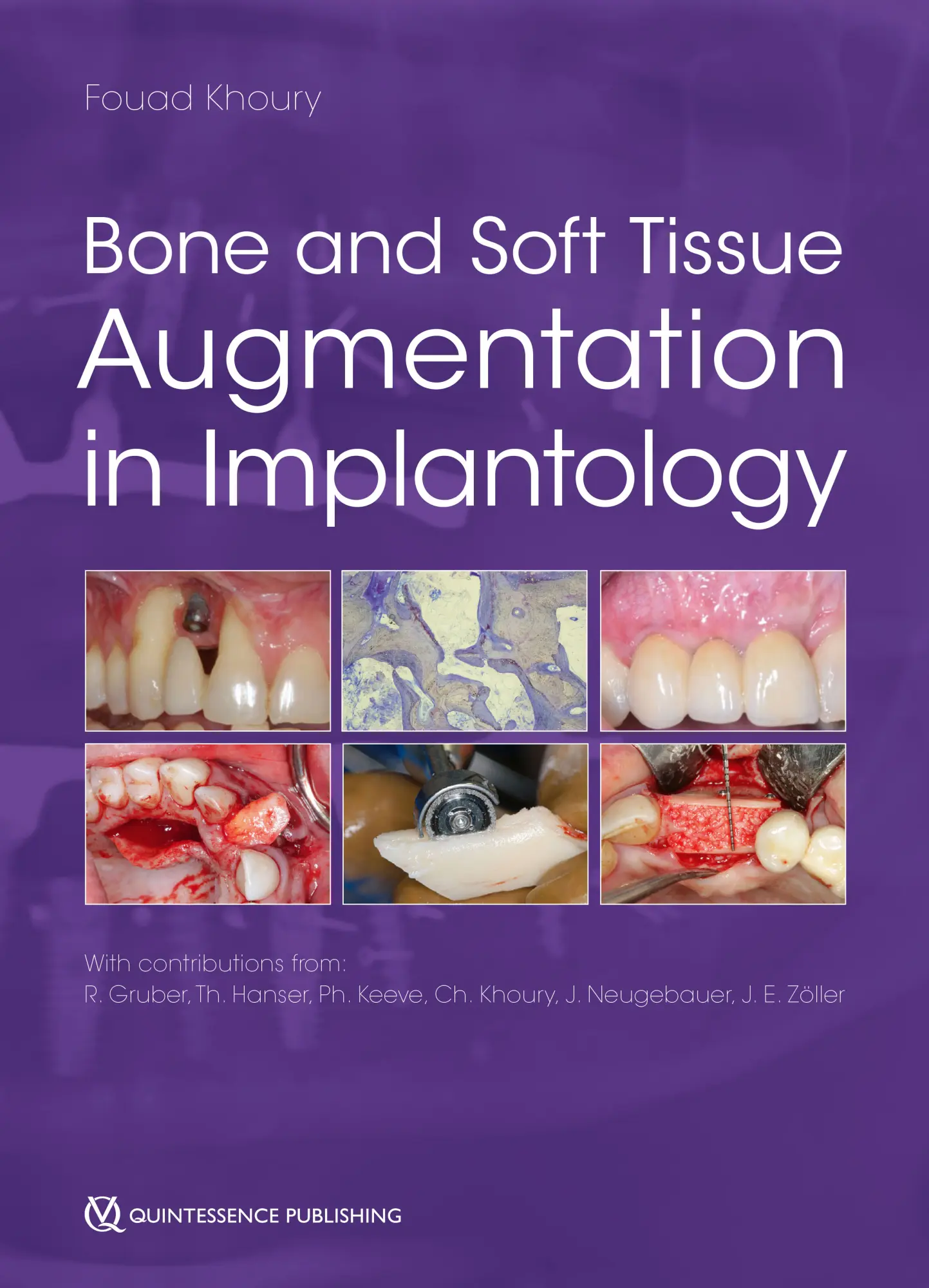 Cover: 9781786981042 | Bone and Soft Tissue Augmentation in Implantology | Buch | 768 S.