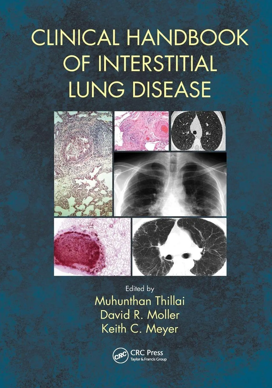 Cover: 9781498768252 | Clinical Handbook of Interstitial Lung Disease | Thillai (u. a.)