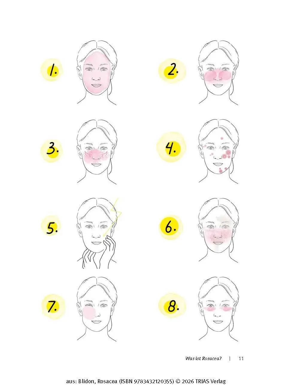 Bild: 9783432120355 | Rosacea | Elke Blidon | Taschenbuch | 176 S. | Deutsch | 2025 | TRIAS
