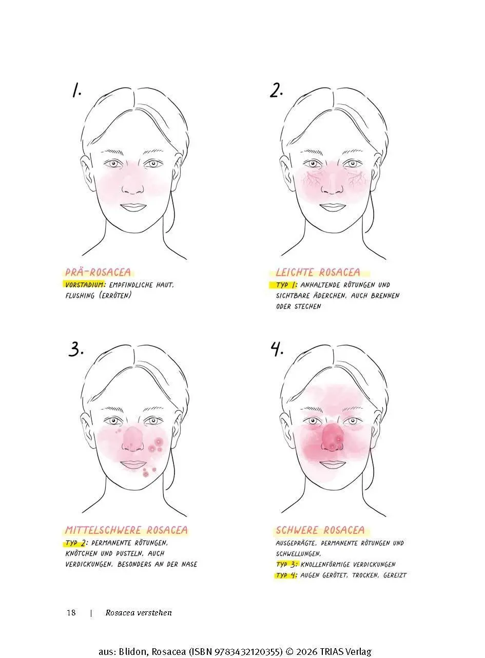 Bild: 9783432120355 | Rosacea | Elke Blidon | Taschenbuch | 176 S. | Deutsch | 2025 | TRIAS