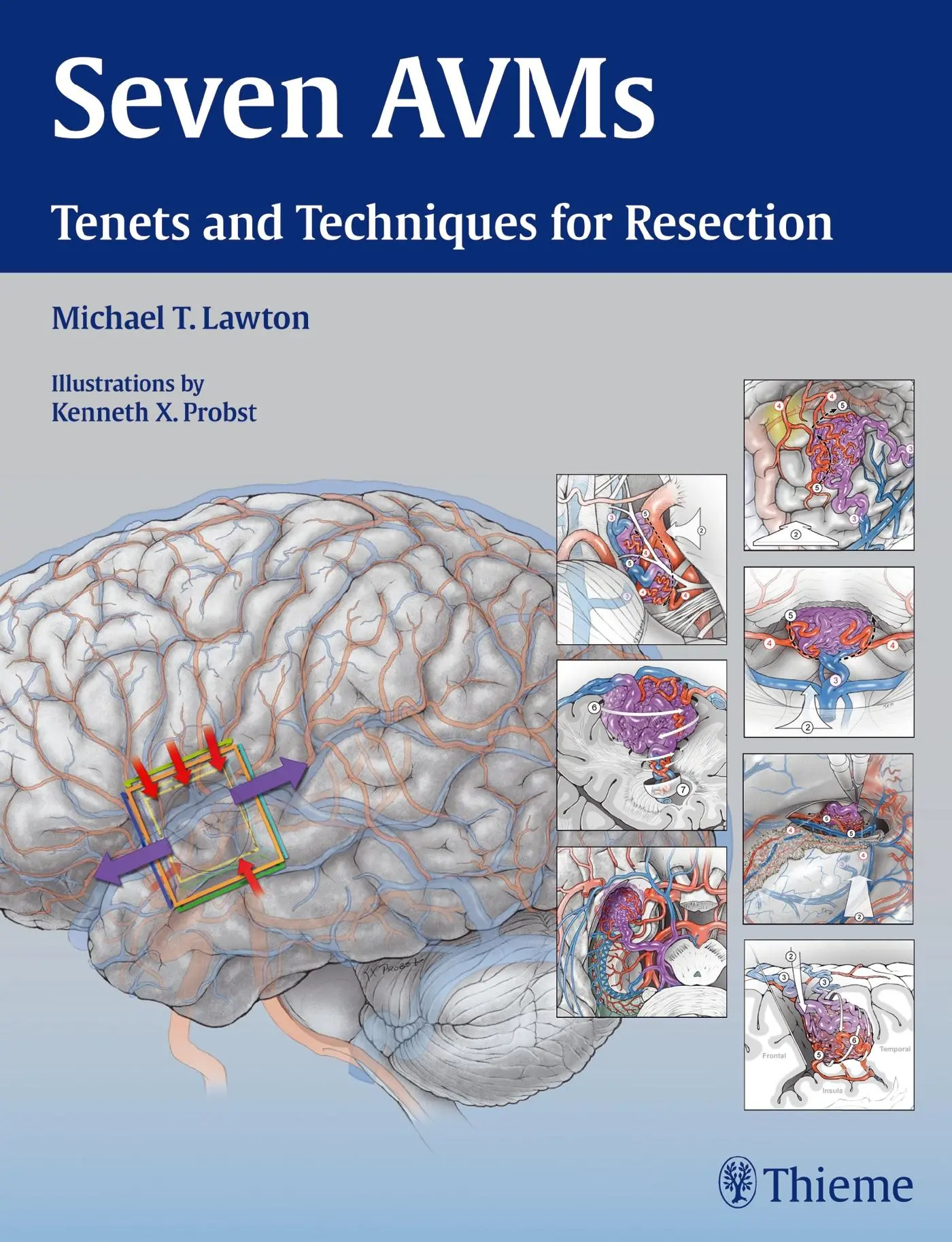 Cover: 9781604068757 | Seven Avms | Tenets and Techniques for Resection | Michael T Lawton