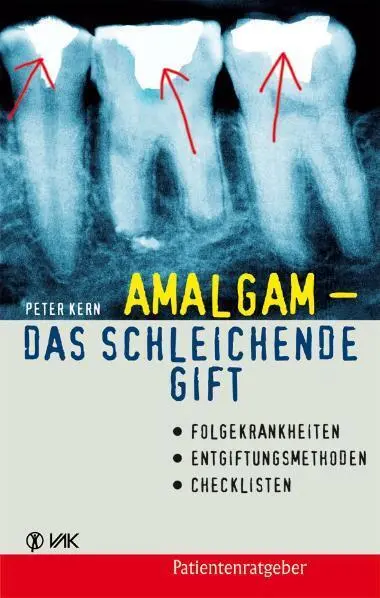 Cover: 9783867310062 | Amalgam - das schleichende Gift | Peter Kern | Taschenbuch | 168 S.