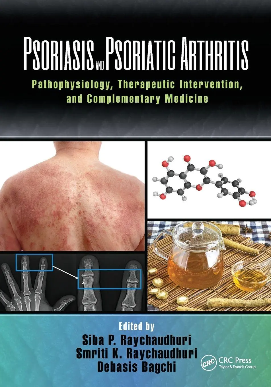 Taylor & Francis Ltd (Sales) Psoriasis And Psoriatic Arthritis