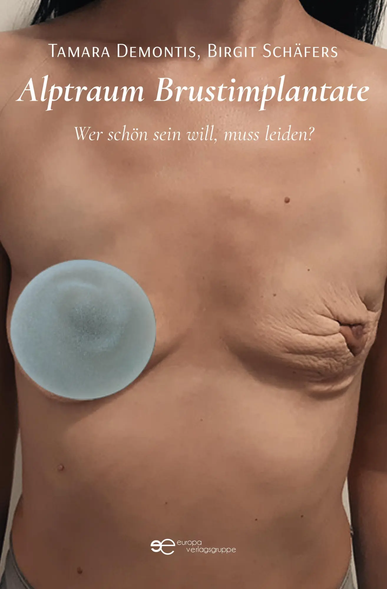 Cover: 9791220144575 | ALPTRAUM BRUSTIMPLANTATE | Wer schön sein will, muss leiden? | Buch