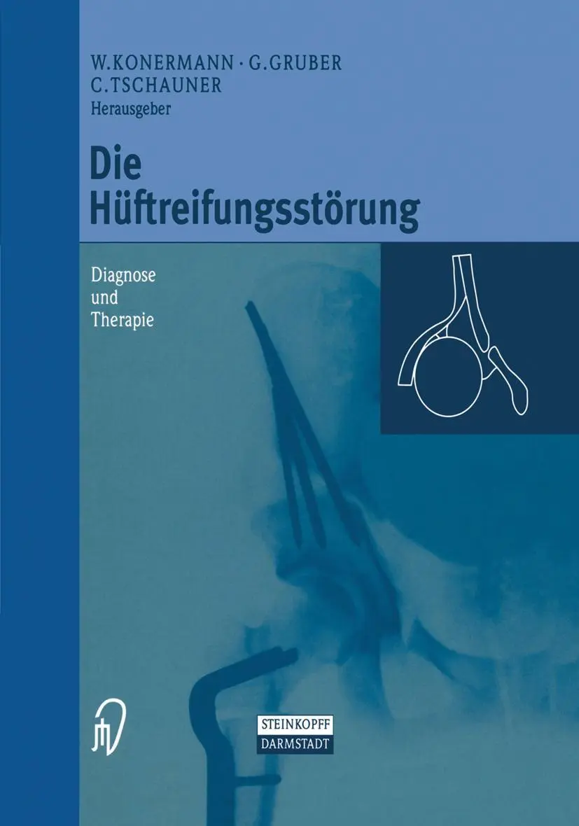 Cover: 9783642636875 | Die Hüftreifungsstörung | Diagnose und Therapie | Konermann (u. a.)