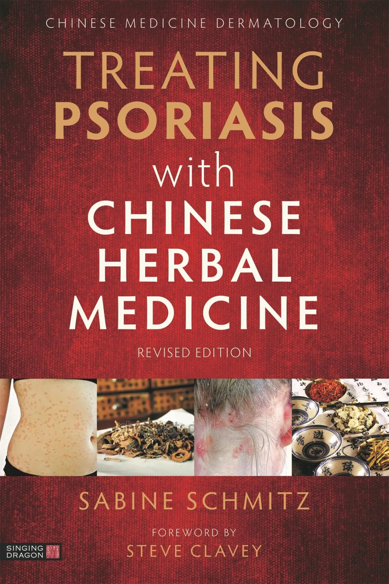 Cover: 9781787753495 | Treating Psoriasis with Chinese Herbal Medicine (Revised Edition)